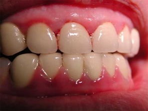 牙龈出血 不可忽视,可能是这些大病征兆 