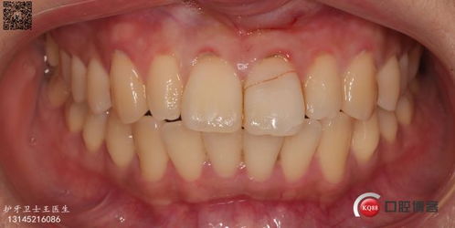 前牙冠折断牙再接病例分享与总结 