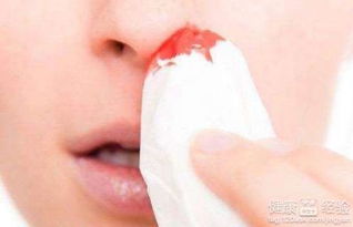鼻孔出血 鼻孔流血是什么原因