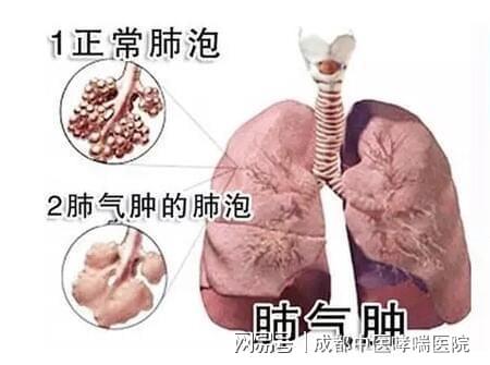 肺气肿能治好吗