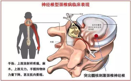 什么是颈椎病 颈椎病真的会瘫痪吗