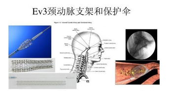 颈动脉支架是只能放一个还是多个