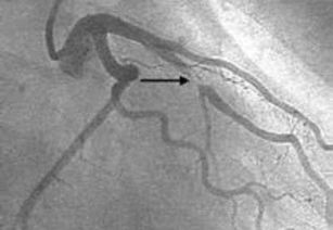 心脏支架植入一年后是否一定要做冠脉造影呢 哪种患者需要做