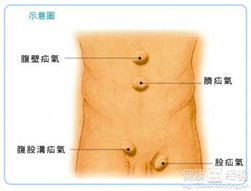 疝气手术完了可能复发吗