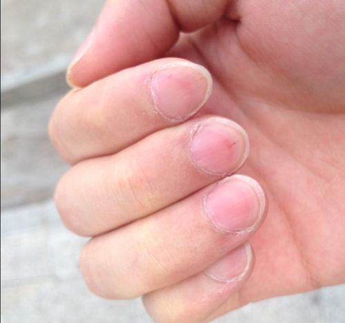 我的十个手指的指甲都这样 如图 ,是不是身体有问题 应该怎么办 