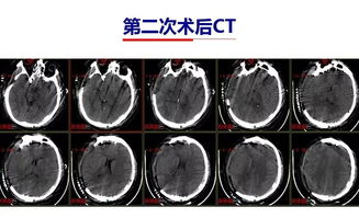 DC术后硬膜下积液合并脑内积水的相关因素及处理 颅脑创伤 神经重症病例周刊 123期