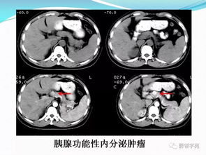 胰腺常见原发肿瘤的CT表现