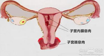 宫颈息肉切除后多长时间愈合