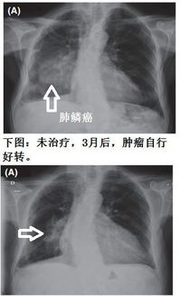 少数晚期肺癌不治疗也会自行好转,涨知识