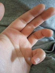 我小拇指的指甲盖是什么情况,要如何处理 