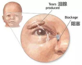 鼻泪管堵塞 婴儿鼻泪管堵塞可以热敷吗我家宝宝？ 