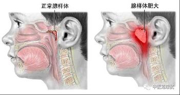 儿童扁桃体腺样体肥大需要手术吗