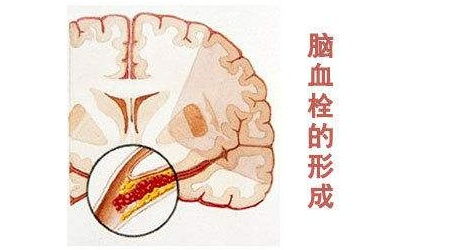 什么东西对脑血管好,什么东西扩张脑血管,什么东西对脑血管有好处