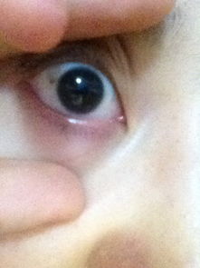 今年发现左眼的眼白有小片黄斑,这是不是隐形眼镜引起的,要怎么治疗 用什么眼药水 能恢复吗 太影响眼 