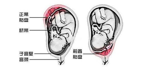 产检报告上的 前壁 和 后壁 是什么意思 对胎儿有什么影响