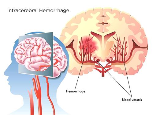颅内出血有什么症状