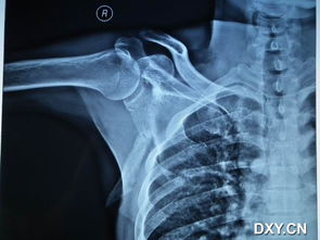 讨论陈旧性肩胛骨粉碎性骨折及肩锁关节脱位如何处理