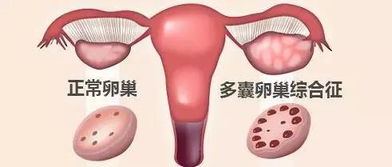 有多囊卵巢综合征女性更容易爆痘吗？