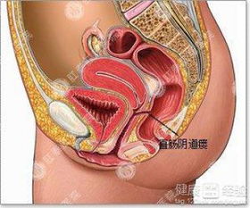 直肠阴道瘘怎么确诊