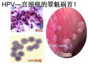 宫颈HPV阳性是怎么回是怎么回事 