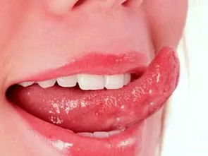 舌头念珠菌感染什么样