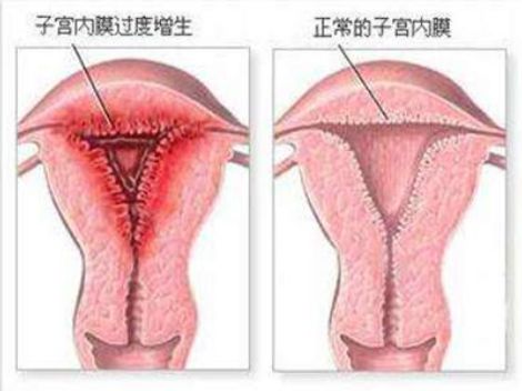 内膜厚怎么办，子宫内膜增厚怎么办