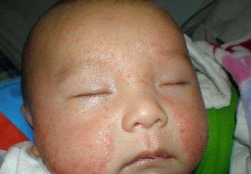 冬季宝宝湿疹又犯了,防治婴儿湿疹,这5招最靠谱 