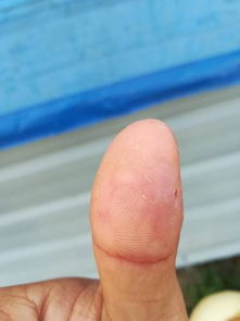 大拇指根部是白的一层层的我把它扣掉了就这个样子,指纹那一块一直在掉皮,指甲根部有小水泡戳穿特别痒 