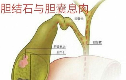 胆囊息肉什么情况下要手术 胆囊息肉该怎么治疗