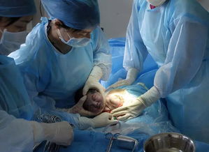 7年5次剖腹产 女人剖腹产最多剖几次