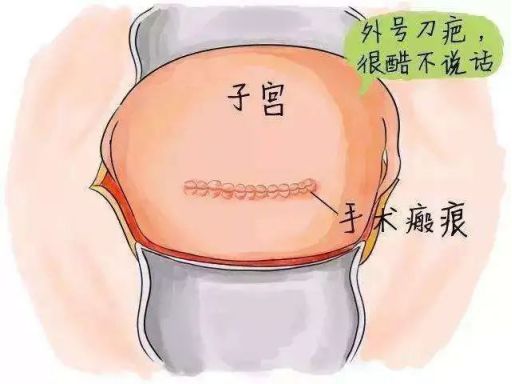 上次剖宫产再次怀孕子宫下段切口部位有些薄要紧吗？