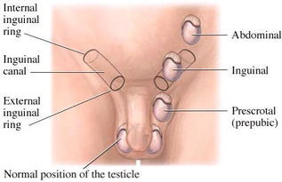 具体了解隐睾的症状表现 