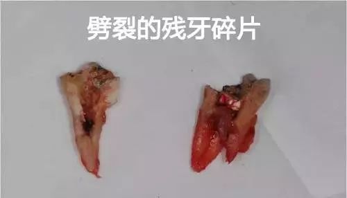 当初蛀牙你不补,如今根管心里苦 花200和花2000你自己看着办吧 