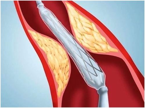 做完支架手术就万事大吉了 朱春芳主任 预防冠心病,还须掌握四大法宝