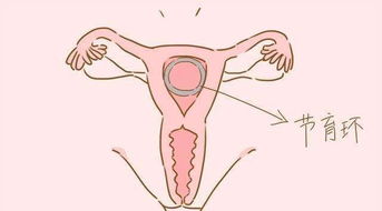 生完二胎后,这2种避孕方式或许比上环更合适,有必要了解一下