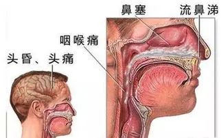 卧龙区第一人民医院耳鼻喉科 鼻窦炎的诊断治疗和预防