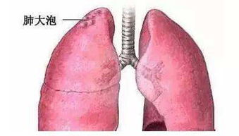 肺大泡疾病引发的后果有多严重 