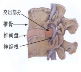 得了腰椎间盘突出千万不要等到腿麻再治疗