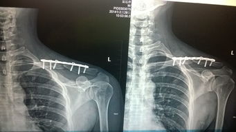 锁骨骨折术后3个月才开始运动的,但现在术后10个月才发现骨头还没长好,还能痊愈吗 概率多大 