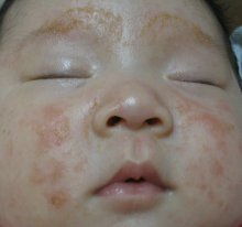 婴儿湿疹后白斑增多,婴儿湿疹后有白斑是怎么回事