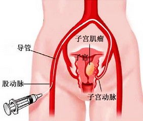 子宫肌瘤和子宫肌腺瘤有什么区别该注意什么(子宫肌腺瘤和子宫肌瘤是一回事吗?)