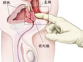 前列腺炎怎么食疗 前列腺炎如何食疗