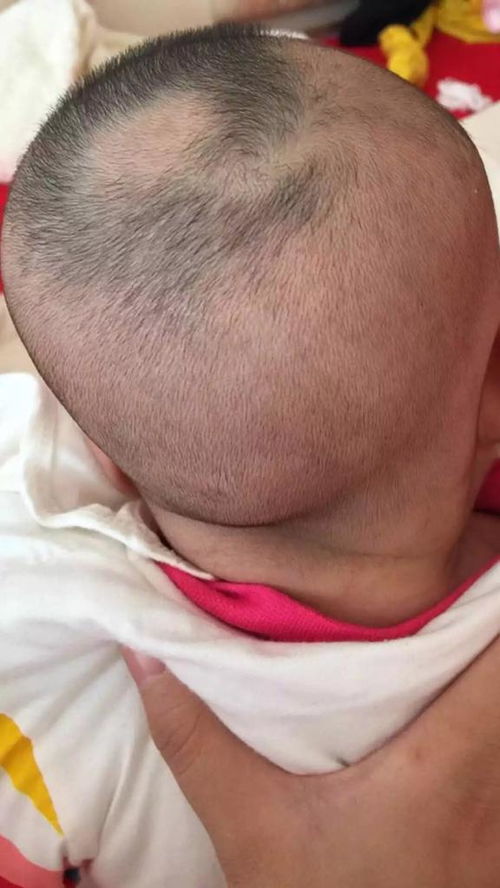 婴儿头发头顶一块长得特别快,而且黑,其他地方都长得很慢,都3个月了,也就2厘米 