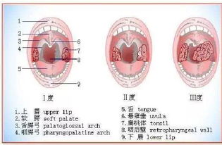 腭咽弓发炎图片 搜狗图片搜索