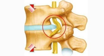 腰椎间盘突出做手术怎么样 腰椎间盘突出不想手术怎么治疗好 