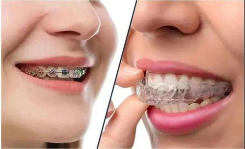 新疆臻美口腔 牙齿矫正中的牙套脸是什么