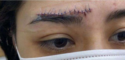 阿娇伤口照曝光,眉骨留下近5厘米蜈蚣疤,伤痕清晰可见