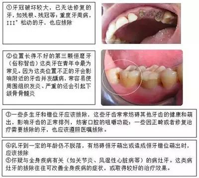 拔牙与牙外伤