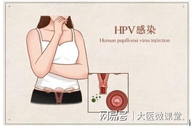 hpv52阳性一定是男人传染的吗,HPV阳性一定是尖锐湿疣吗？