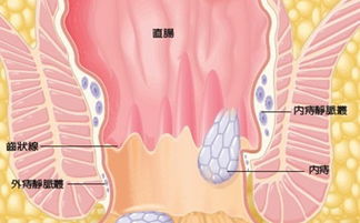 男性长痔疮 先查前列腺